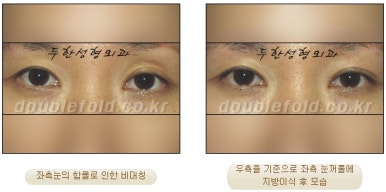 [두한성형외과 쌍커풀수술] - [쌍꺼풀지방이식] 관련 이미지 27