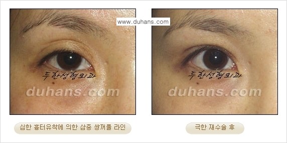 [두한성형외과 경쟁력 눈성형] - [두꺼운 라인을 교정하는 극한 눈 재수술 1.] 관련 이미지 7