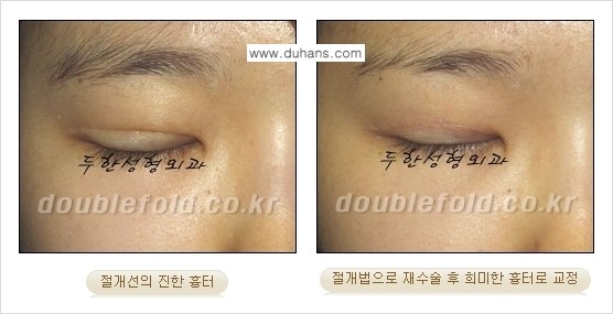 [두한성형외과 경쟁력 쌍꺼풀 재수술] - [흉터선이 진한 경우] 관련 이미지 5