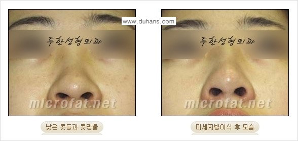 [두한성형외과 경쟁력 코성형] - [미세지방이식을 이용한 자연스러운 코성형 안내] 관련 이미지 11