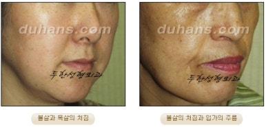 Duhan Plastic Surgery Forehead Surgery - Forehead Lifting Endotine Lifting image 3