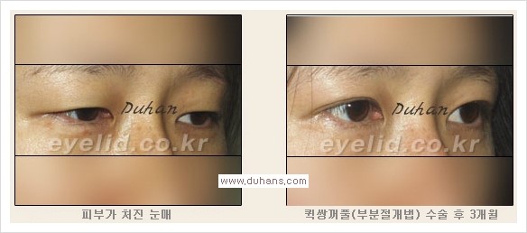 [두한성형외과 경쟁력 눈성형] - [퀵쌍꺼풀(부분절개법) 안내] 관련 이미지 13