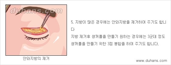 [두한성형외과 성형 FOCUS] - [젊고 환한 눈매 상안검성형 안내] 관련 이미지 6