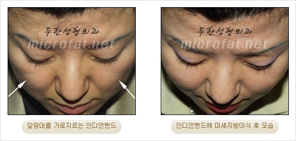 지방이식 두한성형외과 - 입가팔자주름, 인디언주름 지방이식 관련 이미지 33