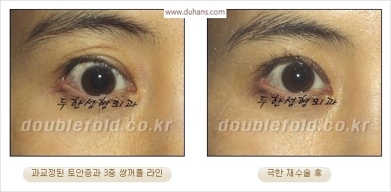 [두한성형외과 경쟁력 눈성형] - [극한 재수술, 함몰된 눈꺼풀 라인교정, 안검하수(졸리운 눈매)] 관련 이미지 17