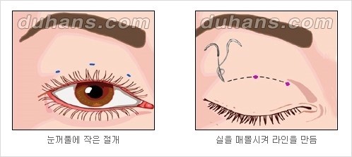 [두한성형외과 경쟁력 눈성형] - [자연스럽고 아름다운 눈매를 위한 쌍꺼풀 수술 ①] 관련 이미지 4