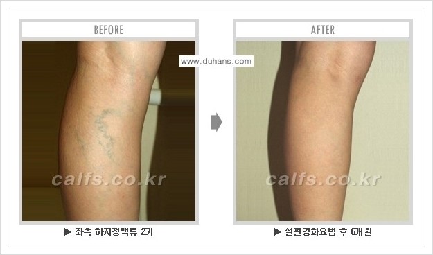 [두한성형외과 경쟁력 정맥류 치료] - [하지정맥류 사진 자료 안내 1.] 관련 이미지 3
