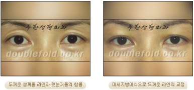 [두한성형외과 쌍커풀수술] - [쌍꺼풀지방이식] 관련 이미지 13