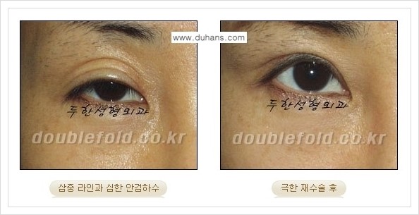 [두한성형외과 경쟁력 쌍꺼풀 재수술, 극한 재수술] - [망친 눈(쌍꺼풀) 복원수술과 일반 쌍꺼풀 재수술과의 차이점] 관련 이미지 6