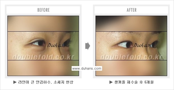 [두한성형외과 쌍꺼풀 재수술] - [눈매교정이 과한 경우의 문제] 관련 이미지 4