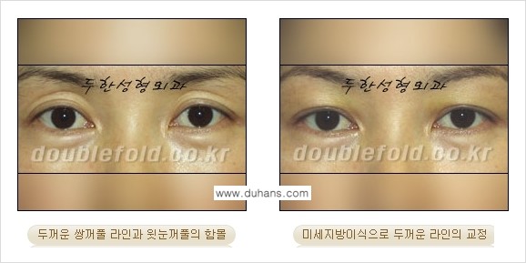 [두한성형외과 NO.1 눈성형] - [함몰된(꺼진) 눈꺼풀에서 쌍꺼풀 라인 교정 2.] 관련 이미지 12