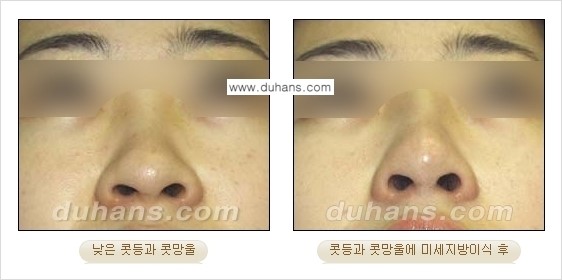 [두한성형외과 경쟁력 미세지방이식] - [코 지방이식 2.] 관련 이미지 4