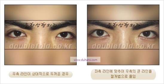 [두한성형외과 경쟁력 눈성형] - [비대칭 쌍꺼풀 라인의 여러 가지 교정 방법] 관련 이미지 6