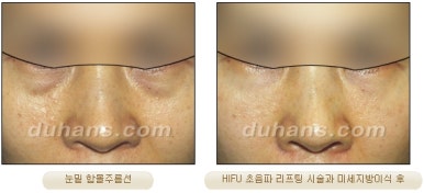 두한성형외과 주름개선 - 주름 HIFU 리프팅 관련 이미지 29