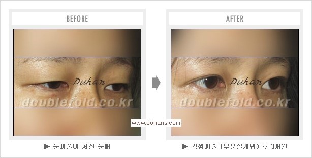 ​[두한성형외과 경쟁력 눈성형] - [퀵쌍꺼풀(부분절개법) 수술 관련 자주하는 질문과 답변] 관련 이미지 10