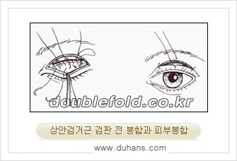 [두한성형외과 경﻿쟁력 눈성형] - [안검하수(졸린눈매) 종류와 교정 수술 안내] 관련 이미지 13