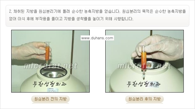 [두한성형외과의 경쟁력 미세지방이식] - [귀족수술과 인디언밴드 미세지방이식 안내 ②] 관련 이미지 8