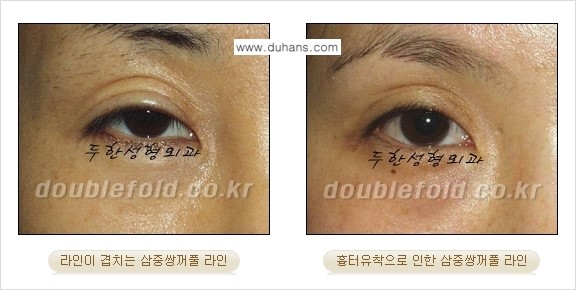 ⁠[두한성형외과 경쟁력 쌍꺼풀 재수술, 극한 눈재수술] - [삼중(세겹) 쌍꺼풀 라인의 교정] 관련 이미지 1