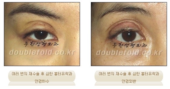 ​[두한성형외과 신두한 원장] - [극한 눈재수술 컬럼] 관련 이미지 2