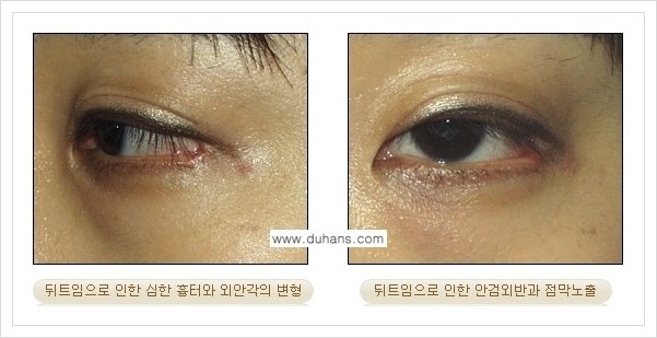 [두한성형외과 경쟁력 있는 쌍꺼풀 재수술] - [뒤트임 수술] 관련 이미지 6