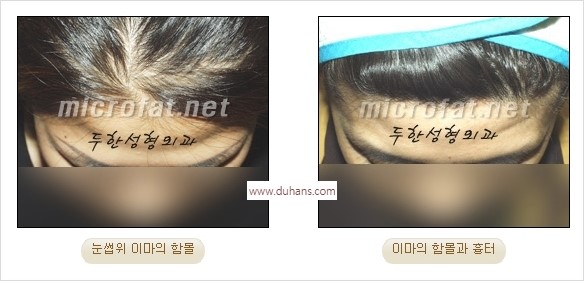 [두한성형외과 경쟁력 동안성형 리더] - ​[미간주름, 이마주름, 안검성형, 이마거상술, 눈썹거상술] 관련 이미지 24