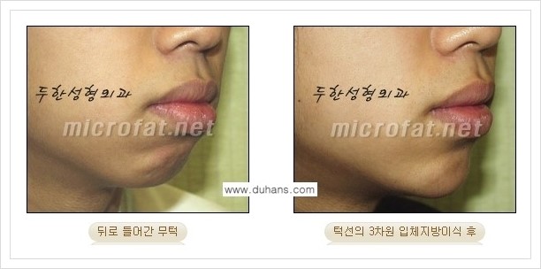 [두한성형외과 경쟁력 안면윤곽 교정] - [미세지방이식으로 무턱, 작은턱, 오목턱, 턱선의 비대칭 교정 안내] 관련 이미지 11