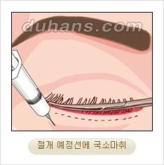 [두한성형외과 경쟁력 동안성형 리더] - ​[미간주름, 이마주름, 안검성형, 이마거상술, 눈썹거상술] 관련 이미지 59