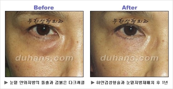 [두한성형외과 경쟁력 동안성형 리더] - ​[미간주름, 이마주름, 안검성형, 이마거상술, 눈썹거상술] 관련 이미지 104
