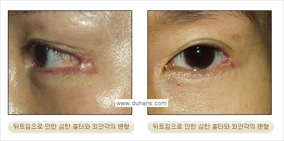 [두한성형외과 경쟁력 눈성형] - [뒤트임 수술 부작용 안내] 관련 이미지 4