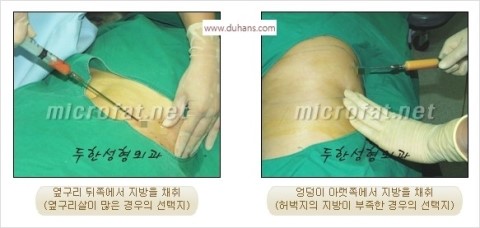 [두한성형외과 경쟁력 귀족성형] - [3차원 입체 미세지방이식 귀족수술 + 인디언밴드 교정] 관련 이미지 30