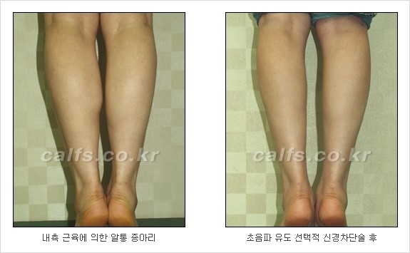 [두한성형외과 경쟁력 종아리성형] - [초음파 유도 선택적 신경차단술 안내 ④] 관련 이미지 10