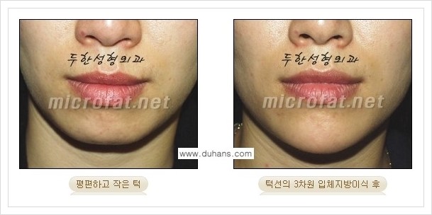 ⁠⁠[두한성형외과 경쟁력 미세지방이식] - [턱 미세지방이식 - 안면윤곽 교정 안내] 관련 이미지 15