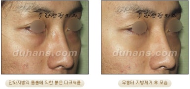[두한성형외과 지방제거] - [눈두덩이지방제거, 눈밑지방제거] 관련 이미지 50