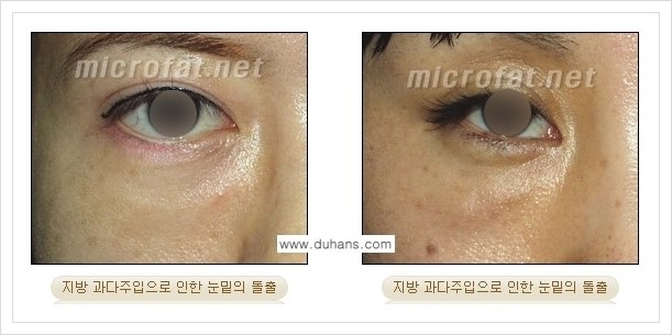 ​[두한성형외과 경쟁력 미세지방이식] - [타병원에서의 미세지방이식 부작용 종류와 문제점 안내] 관련 이미지 5