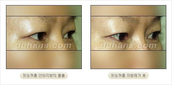 [두한성형외과 경쟁력 지방제거] - [눈꺼풀 지방제거 흔한 질문과 답변 모음] 관련 이미지 4