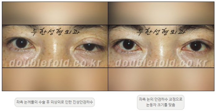 [Ptosis, Duhan Plastic Surgery] - [Sleepy-Looking Eyes, Ptosis Eye Correction] image 5