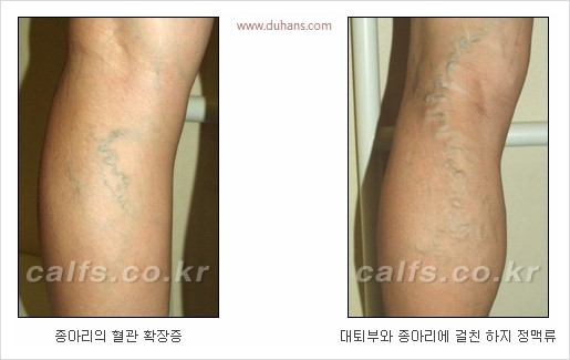 [두한성형외과 경쟁력 종아리성형 리더] - [종아리 성형 안내] 관련 이미지 16