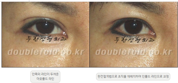 [Double Eyelid Surgery Duhan Plastic Surgery] - [Revision Methods] image 8