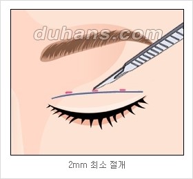[두한성형외과 경쟁력 눈성형 리더] - [아름다운 눈매를 위한 쌍꺼풀 수술 안내] 관련 이미지 5