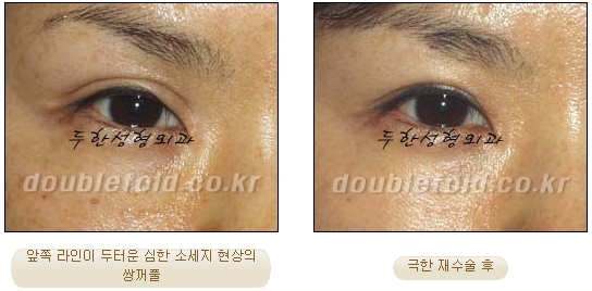 [DoubleFold Plastic Surgery Eye Surgery] - [Revision Surgery for Thick Double Eyelids] image 31