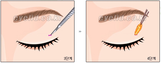 [두한성형외과 지방제거] - [눈두덩이지방제거, 눈밑지방제거] 관련 이미지 5