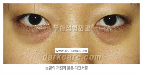 [두한성형외과 FOCUS 눈밑성형] - [다크써클의 치료방법 -  콜펫(Col-fat) 눈밑 미세지방이식 ②] 관련 이미지 3