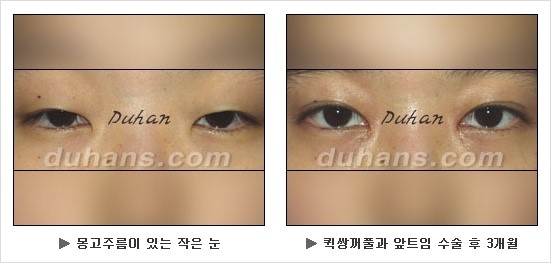 [두한성형외과 쌍커풀수술] - [눈성형 방법에 대한 자주하는 질문과 답변] 관련 이미지 113