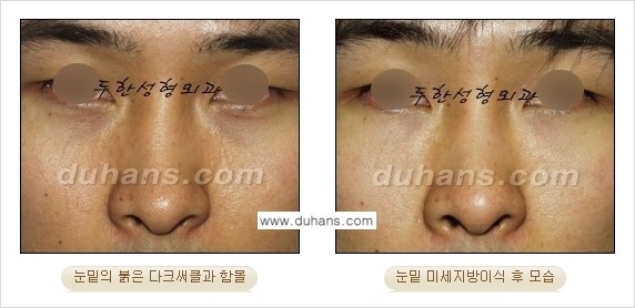[두한성형외과 상큼하고 환한 눈매완성] - [눈밑 미세지방이식 ①] 관련 이미지 12