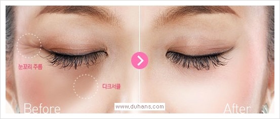 [두한성형외과 경쟁력 다크써클 치료] - [다크써클 + 눈꼬리 보톡스 콤비 프로그램] 관련 이미지 1