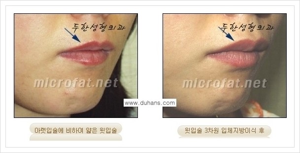 [두한성형외과 경쟁력 미세지방이식] - [입술 미세지방이식 안내 2.] 관련 이미지 10