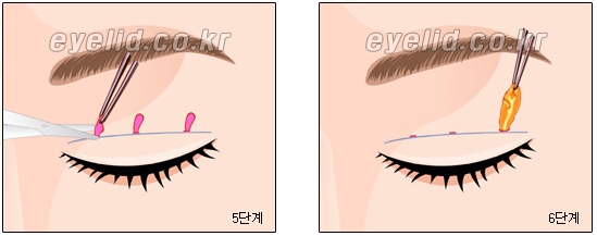 [Double Eyelid Surgery Duhan Plastic Surgery] - [Buried Method, Incision Method, Partial Incision Method] image 22