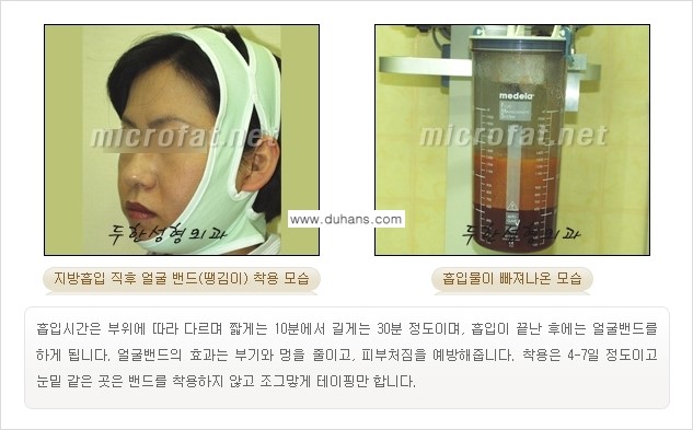 [두한성형외과 "미세지방이식"] - [지방이식 부작용 교정 정보 ②] 관련 이미지 5