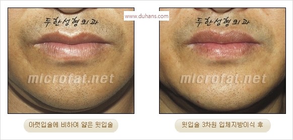 ​​[두한성형외과 경쟁력 미세지방이식] - [볼륨감 있는 입술성형] 관련 이미지 10