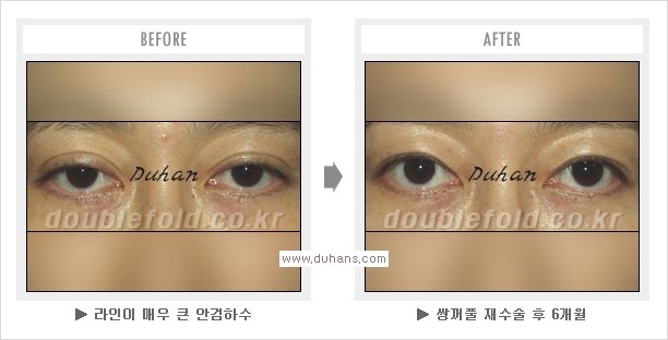 [두한성형외과 경쟁력 쌍꺼풀 재수술, 극한 눈재수술] - [망친 쌍꺼풀, 망가진 쌍꺼풀 복원수술, 재수술의 성공요건] 관련 이미지 7